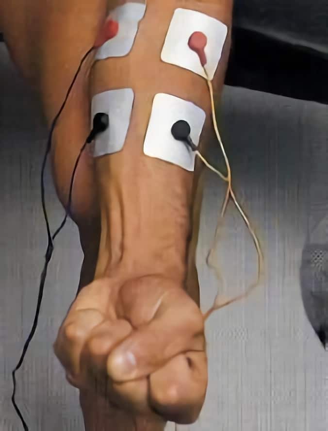 Colocación de electrodos en flexores de la mano