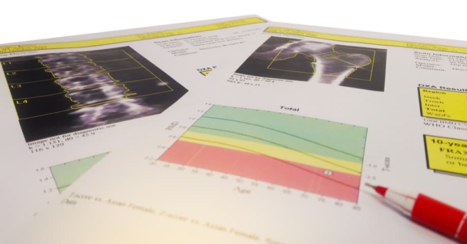 Informe diagnóstico de osteoporosis