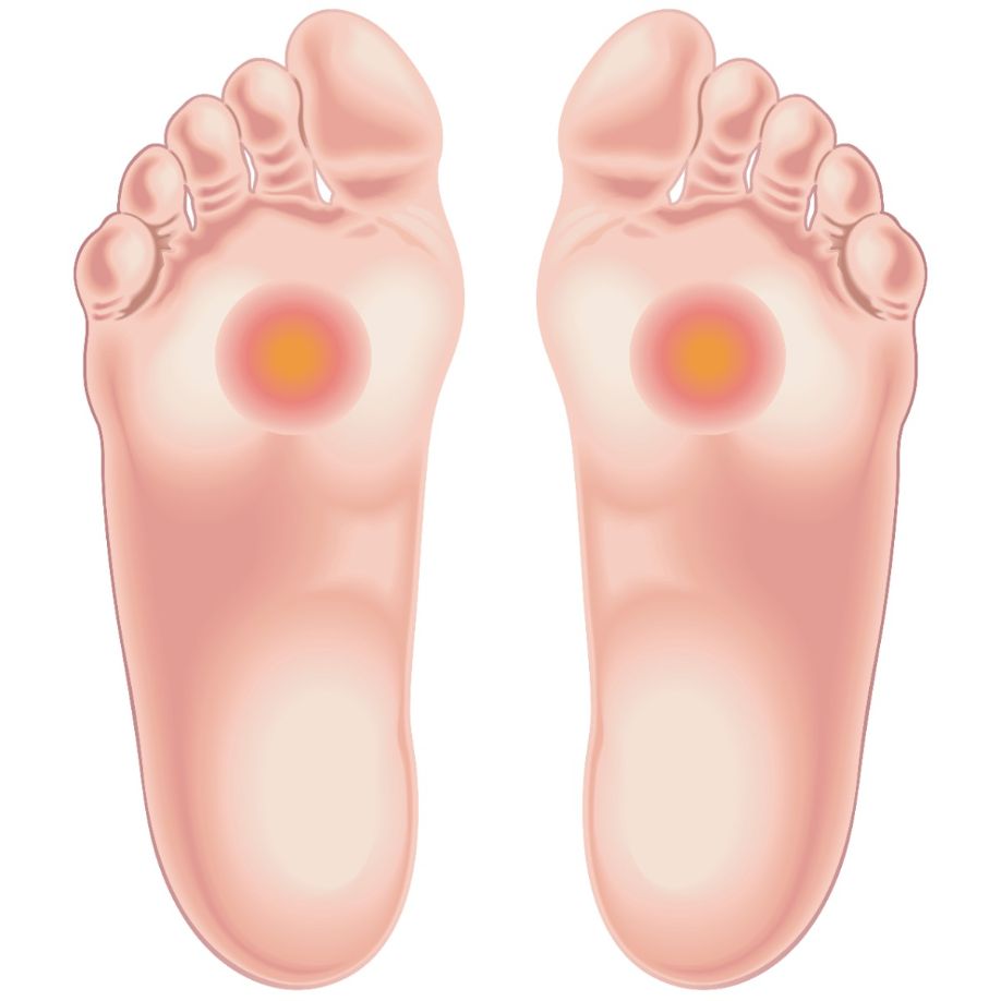 Ilustración del área de los pies afectada por dolor por metatarsalgia