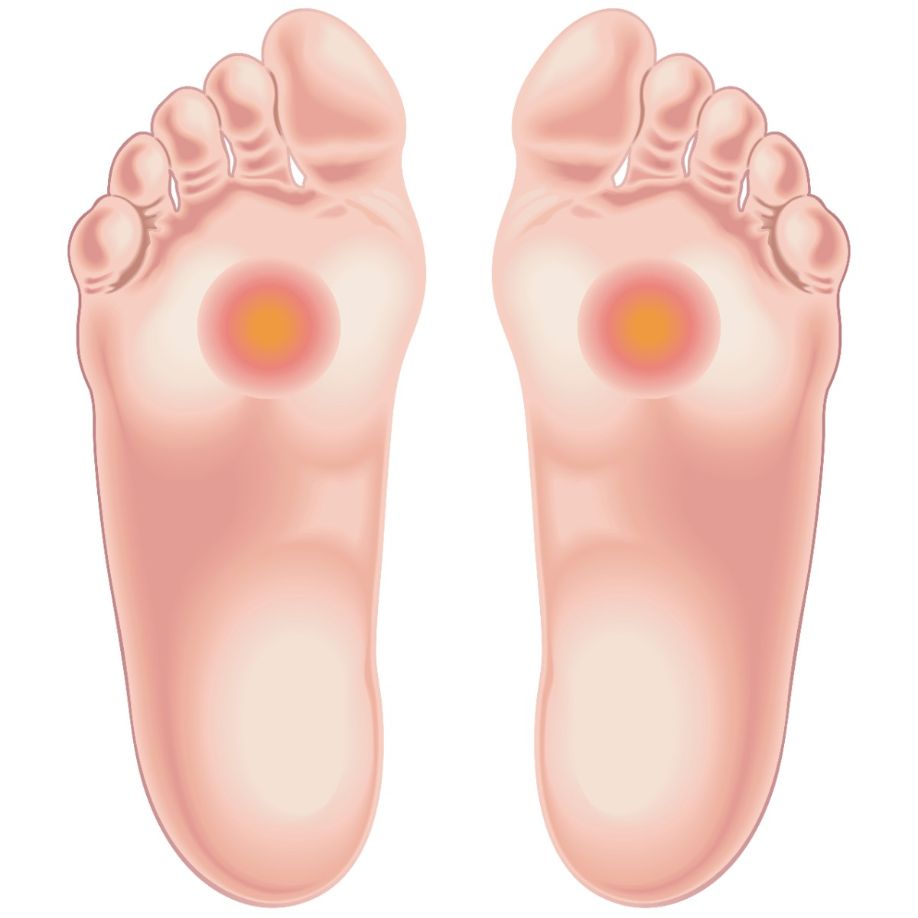 Ilustración del área de los pies afectada por dolor por metatarsalgia