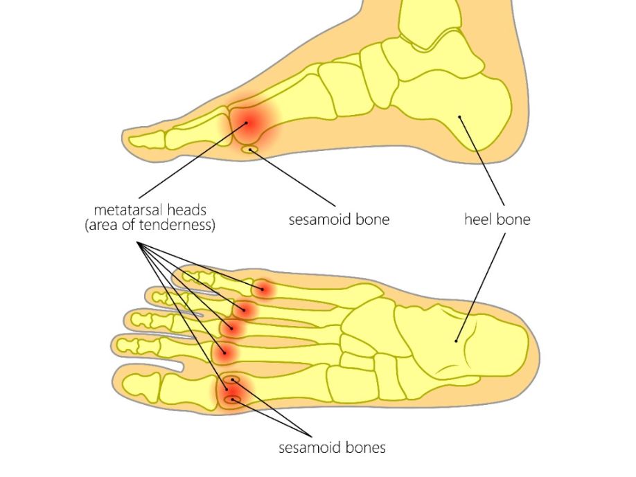 Sensibilidad en las bolas de los huesos metatarsianos del pie