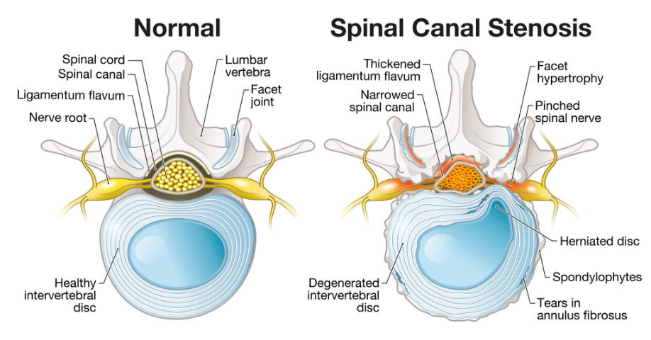 Ilustración de espina dorsal con estenosis