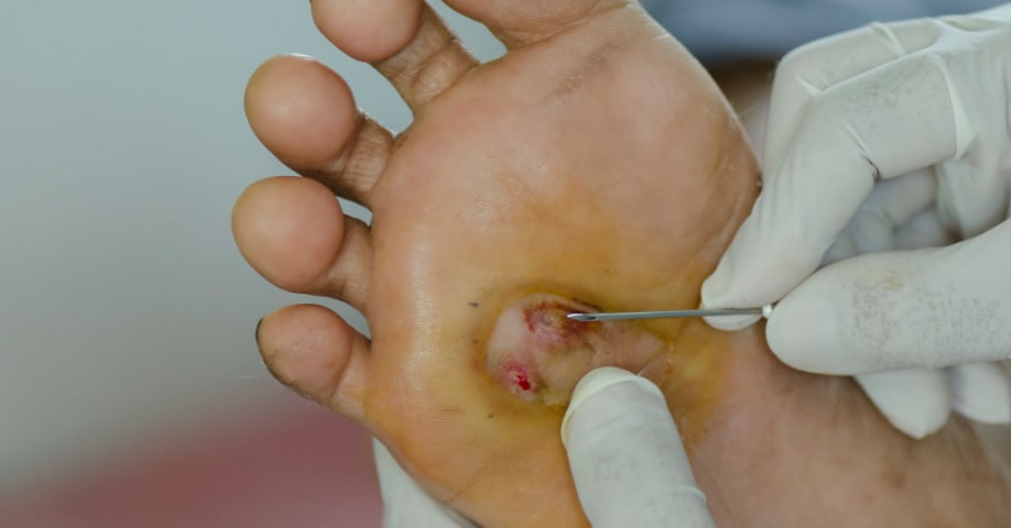 Limpiando una úlcera cutánea en el pie