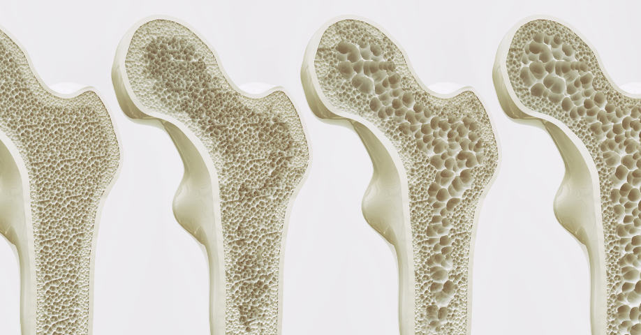 Comparación de hueso sano y hueso con osteoporosis
