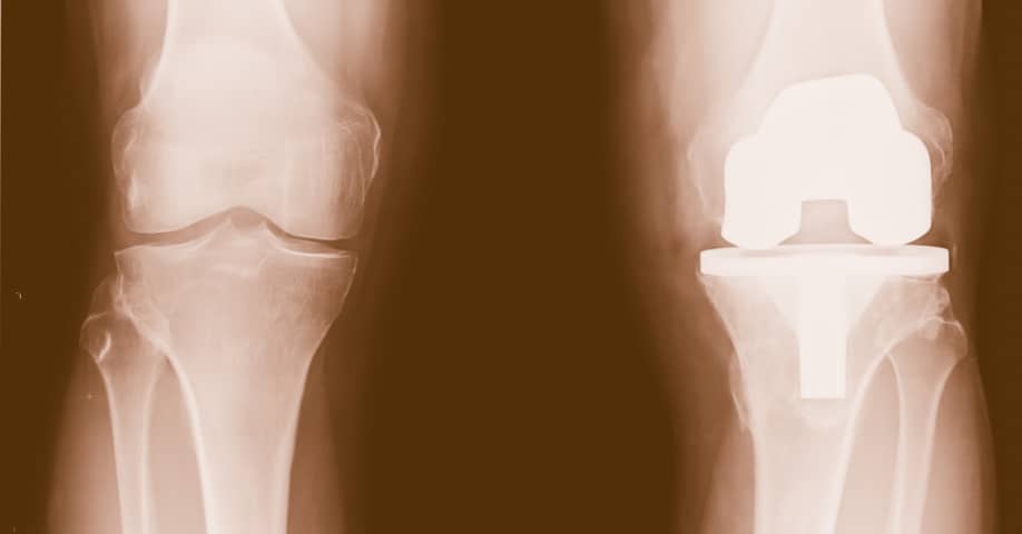Imagen de rayos X de prótesis de rodilla