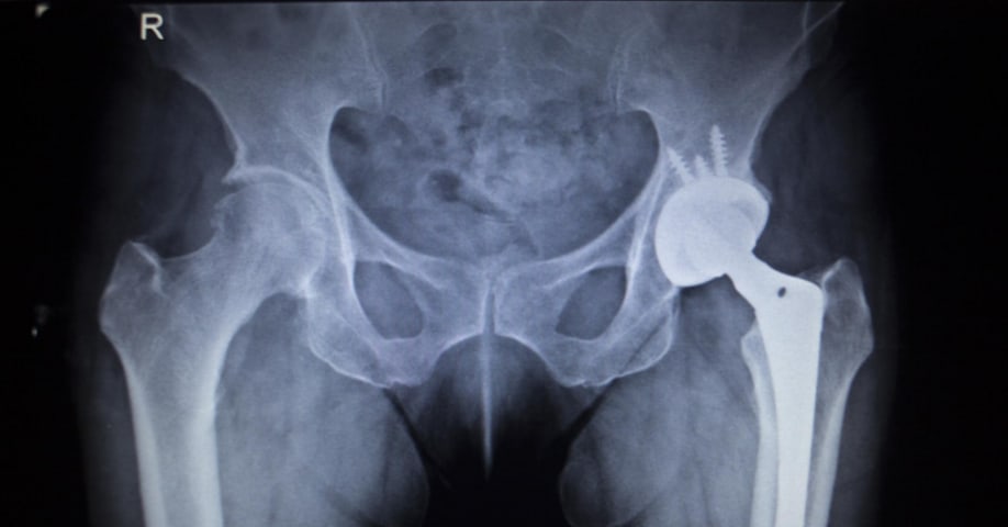 Radiografía Coxartrosis cadera