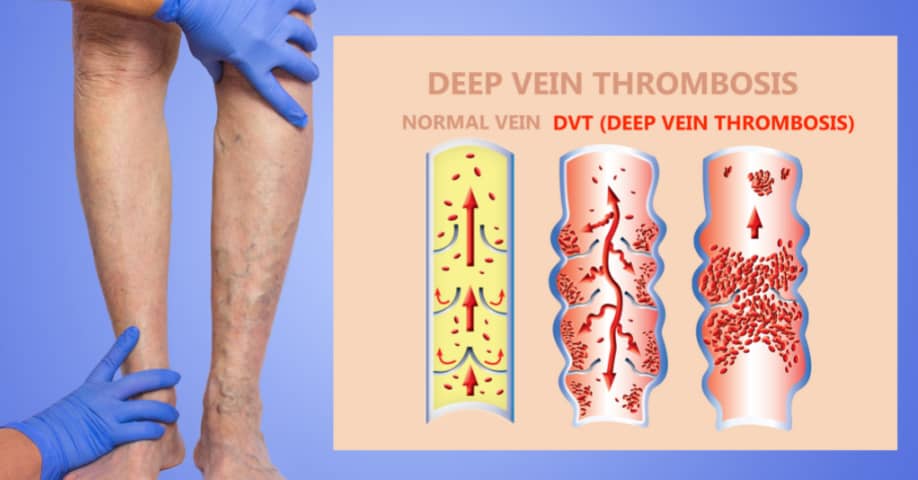 El tratamiento de presoterapia para trastornos circulatorios