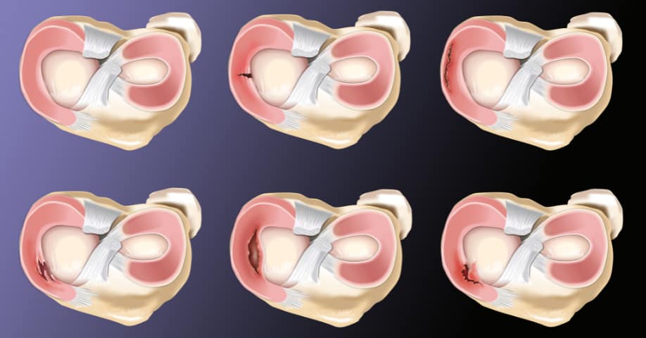 Comparativa de menisco roto y otras lesiones
