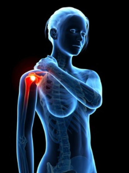 Diatermia en artrosis de hombro