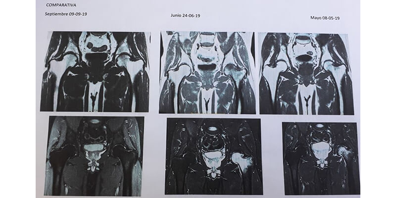 CASO CLÍNICO: Evolución de un paciente con edema óseo tratado con magnetoterapia