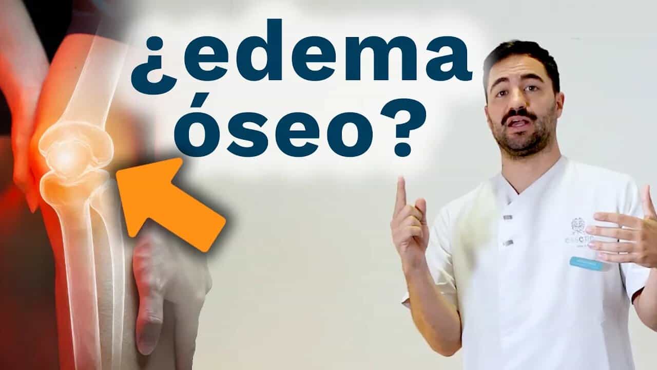 ¿Cómo es el tratamiento de magnetoterapia en edema óseo?