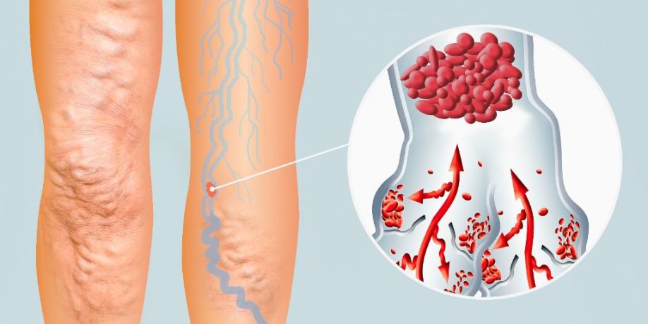 ¿Qué es la flebitis? Tipos y tratamiento