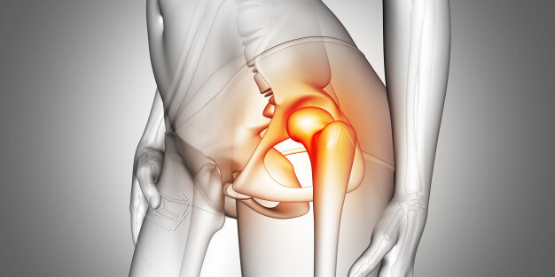 Trocanteritis o bursitis de cadera y cómo tratarla con magnetoterapia